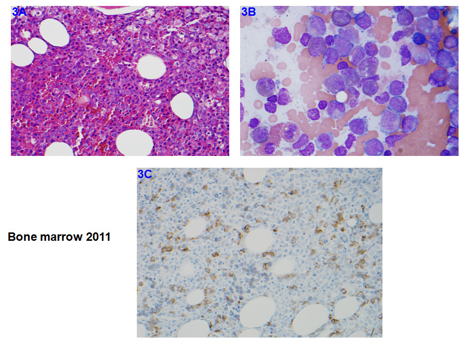 Figure 3. Bone marrow evaluation in 2011. A. H&E section of marrow biopsy showing hypercellular marrow with increased blasts; B. Bone marrow aspirate smear showing increased blasts and myeloid left shift; C. IHC of CD34 highlighting increased CD34+ blasts.